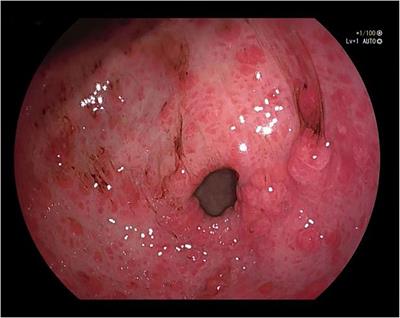 A case report of adult juvenile polyposis syndrome with SMAD4 pathogenic variant